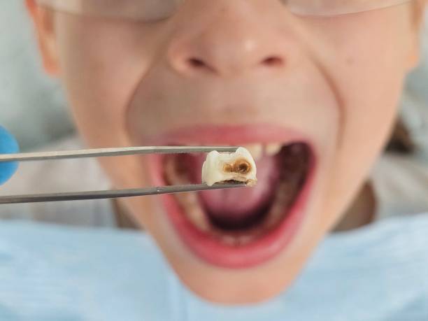 Best Emergency Dentist for Lost Fillings or Crowns in Danielson, CT